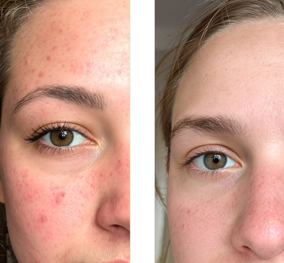 Salicylsyre-toner mod urenheder og store porer — Salicylsyre peeling fjerner hudorme, mindsker porer og udjævner huden. Bruges dagligt for en klar og ren hud.