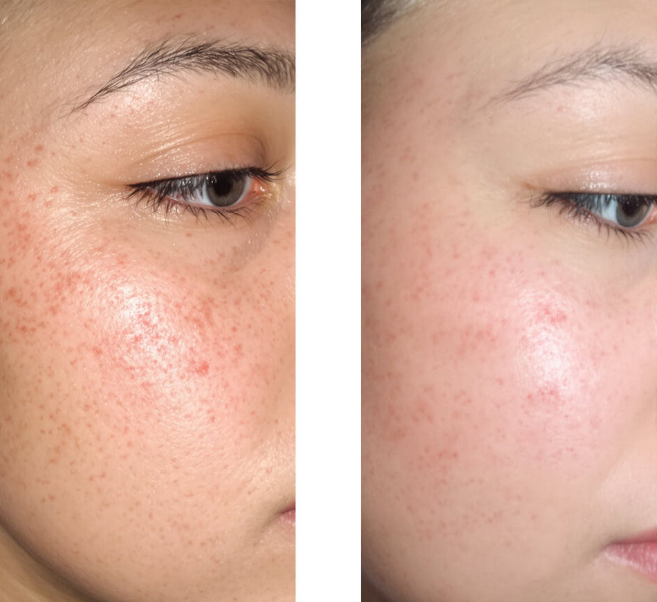 Serum mod bumser, hudorme og uren hud – Salicylsyre 2 % — Serum mod bumser og fedtet hud. Renser porer og dæmper udbrud. Med salicylsyre 2 %, Zinc PCA, grøn te og hyaluronsyre.